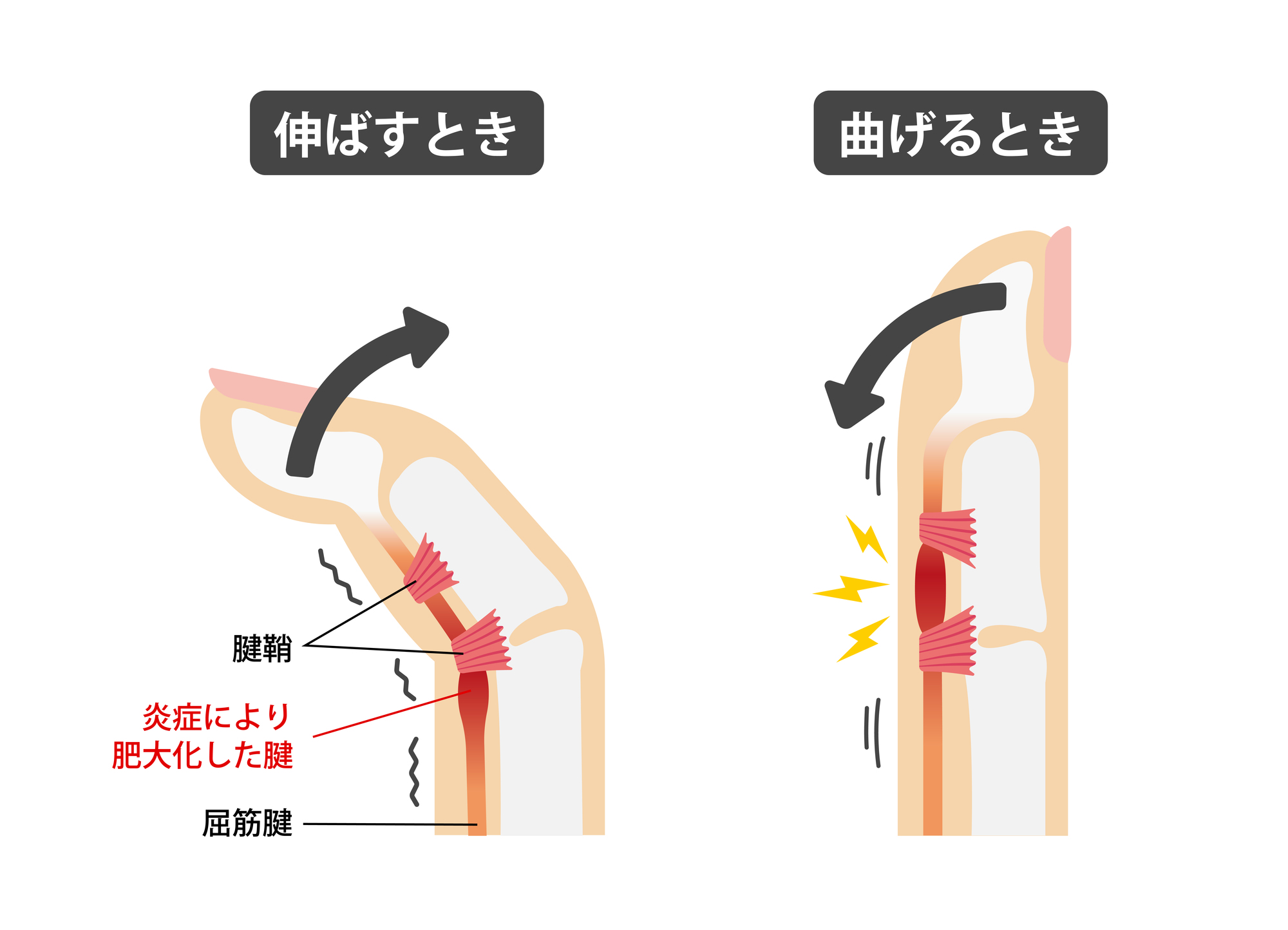 ばね指